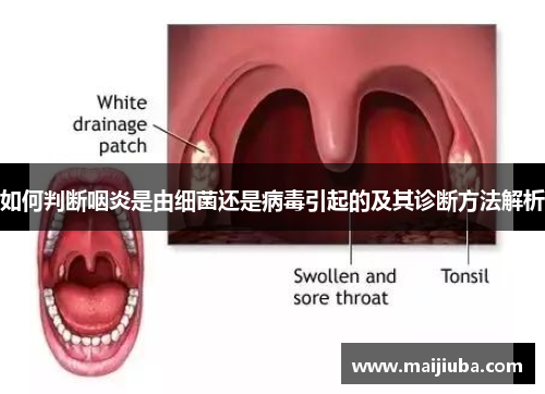 如何判断咽炎是由细菌还是病毒引起的及其诊断方法解析